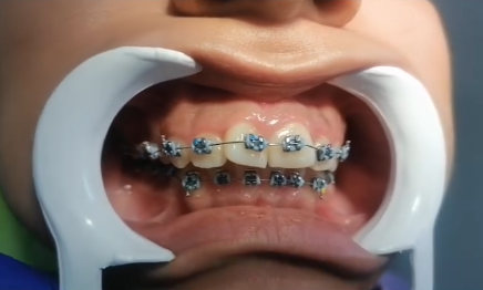 Sonrisa de paciente con brackets en ambas arcadas mostrando la alineación de los dientes