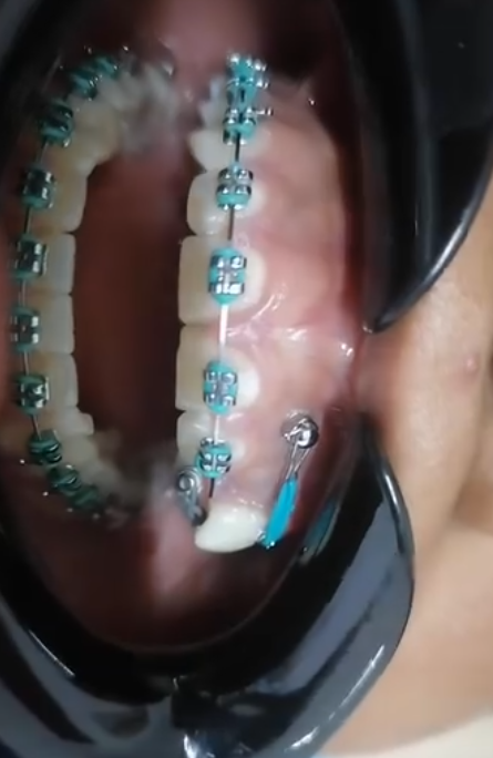 Paciente con brackets metálicos y ligas color turquesa durante su tratamiento de ortodoncia