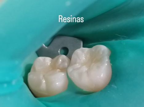 Restauraciones con resina en molares con acabado natural del color del diente